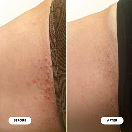 Bushbalm Ingrown Hair Oil - Vanilla Coconut