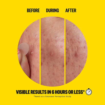 Peace Out Acne Day Dots - Jumbo