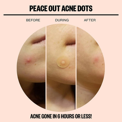 Peace Out Acne Dots - 10 Pack