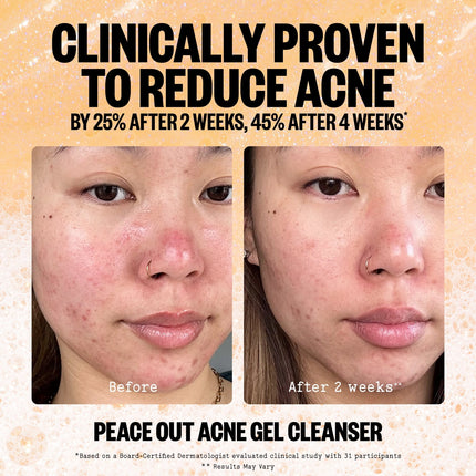 Peace Out Acne Gel Cleanser