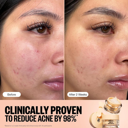 Peace Out Acne Gel Moisturizer