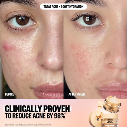 Peace Out Acne Gel Moisturizer