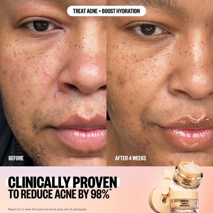 Peace Out Acne Gel Moisturizer