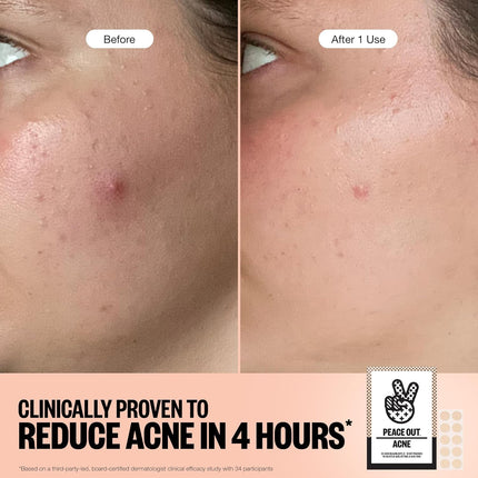 Peace Out Acne Healing Dots Jumbo