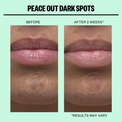 Peace Out Dark Spots Microneedling Dots