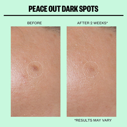 Peace Out Dark Spots Microneedling Dots