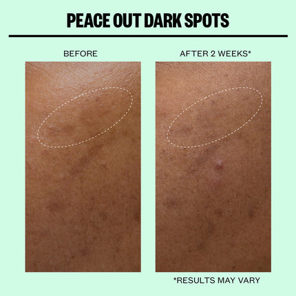 Peace Out Dark Spots Microneedling Dots